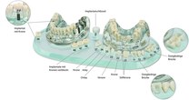 Studienmodell Demo Implant C+B